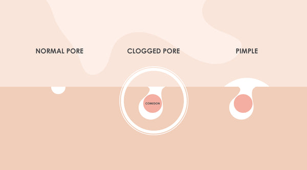What Causes Clogged Pores & How to Clear Them