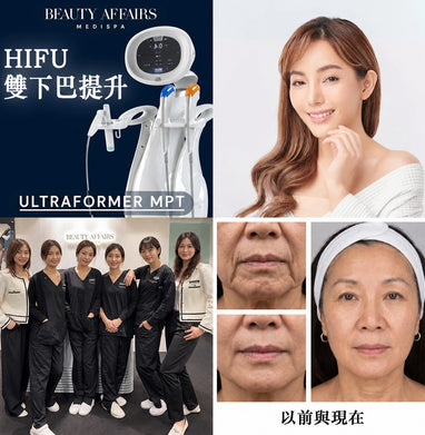 HIFU Ultraformer MPT 雙下巴塑形療程 - 中環