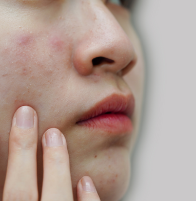 Bespoke Luxury Acne & Scar Removal Henry House